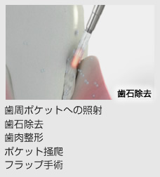 歯周ポケットへの照射、歯石除去、歯肉整形、ポケット掻爬、フラップ手術